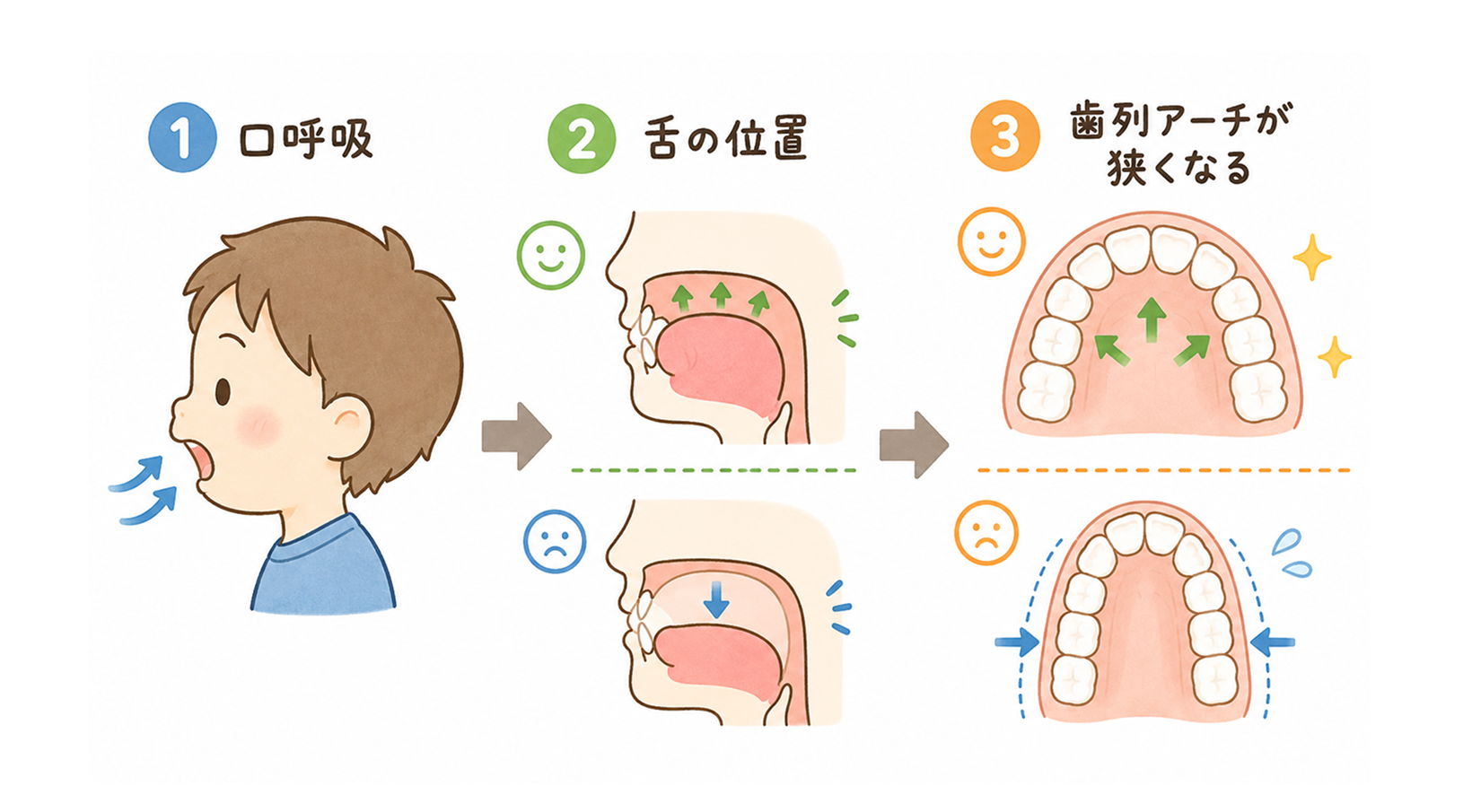 口呼吸から舌の位置、歯列アーチが狭くなるまでの3ステップ