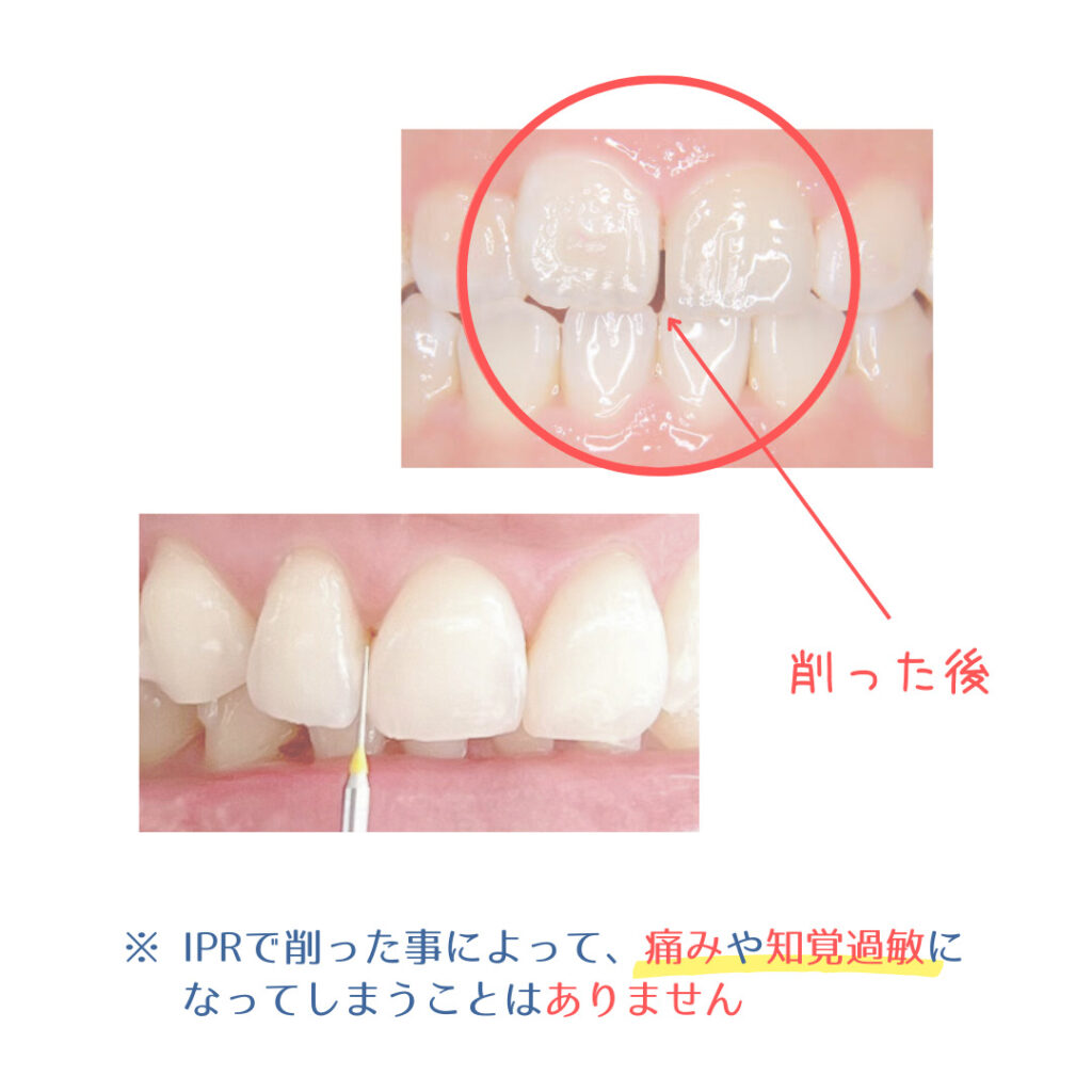 歯を削るの?IPRとは?質問に答えます! | 長崎マウスピース矯正歯科